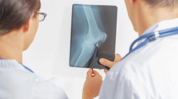 A térdízület arthrosisának szükséges diagnózisa után az orvosok komplex kezelést írnak elő