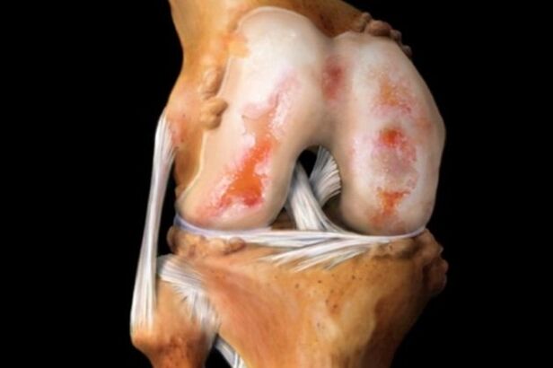 A térdízület megsemmisítése az arthrosis miatt - a mozgásszervi rendszer gyakori patológiája