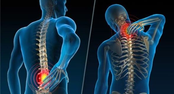 Az osteochondrosis kialakulását jelző jelek - fájdalom a nyakban és a hát alsó részén