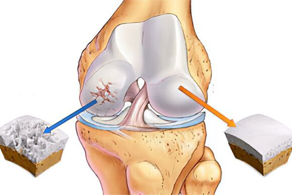 Mi az arthrosis