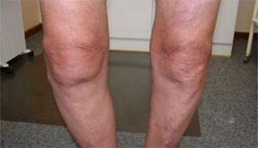 az arthrosis tünetei