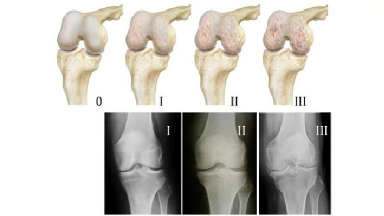 A térdízület arthrosisának szakaszai röntgenfelvételeken