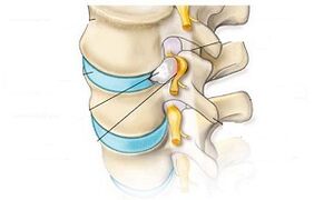 A nyaki osteochondrosis fő tünetei