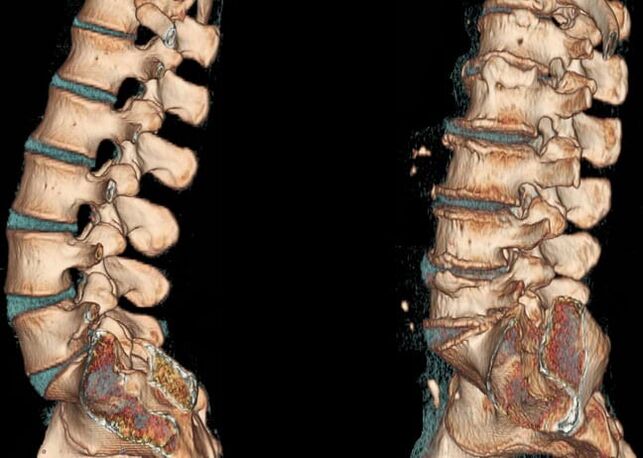 Az ágyéki gerinc CT-vizsgálata normál állapotban és osteochondrosisban